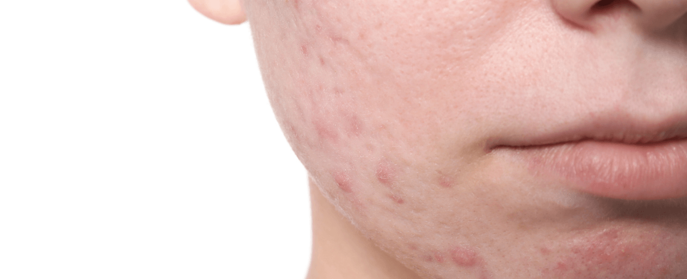 Young boy's cheek with acne marks