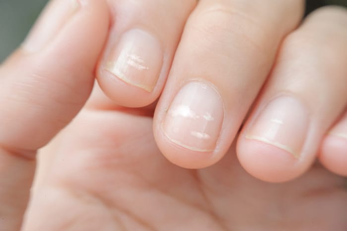 A closeup of visible white spots on fingernails