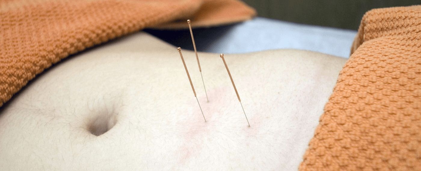 A person's belly with acupuncture needles inserted