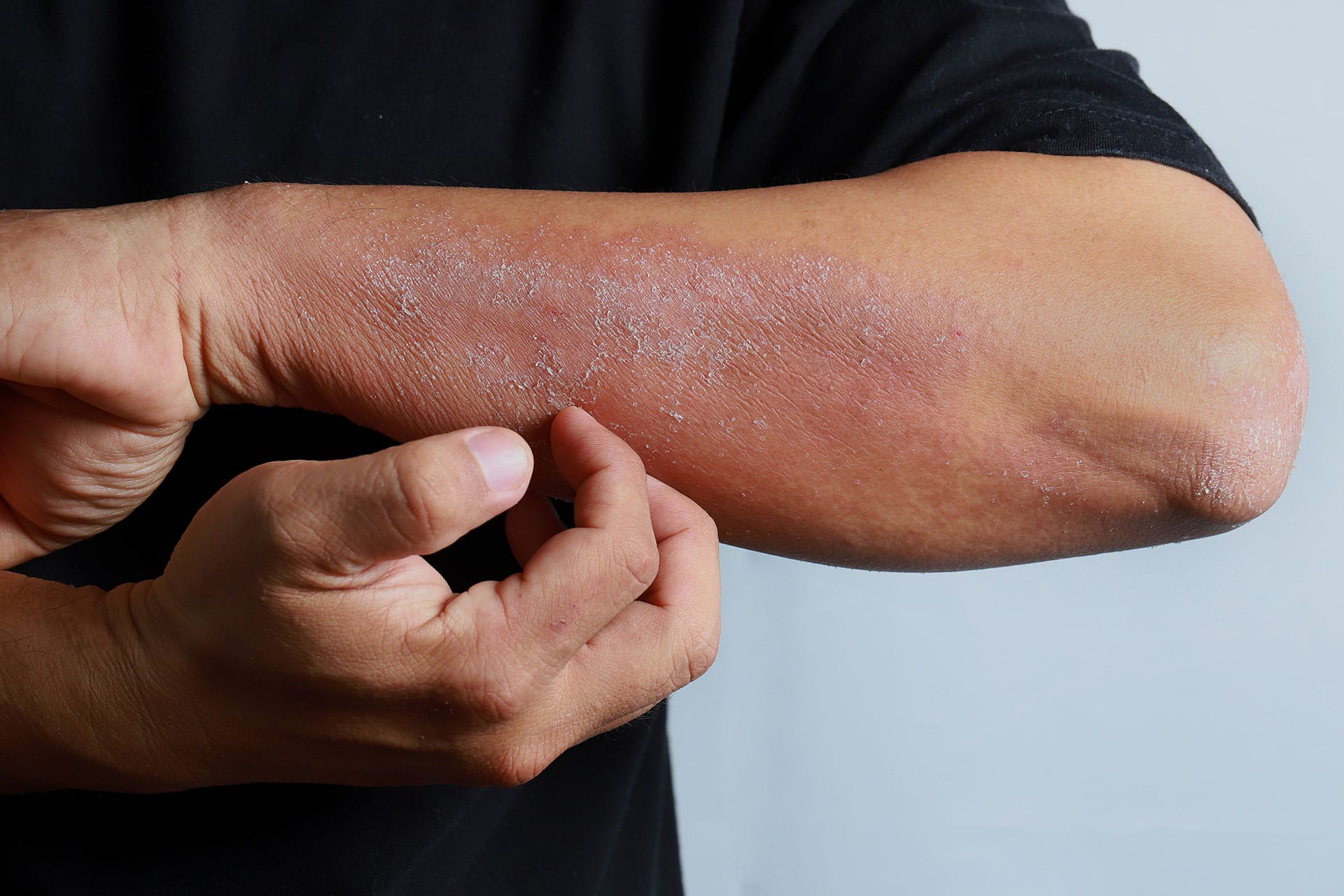 Man scratching skin looking for a homemade eczema remedy