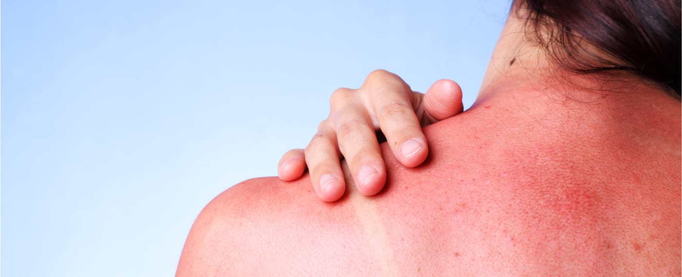Woman with severe sunburn touching her back
