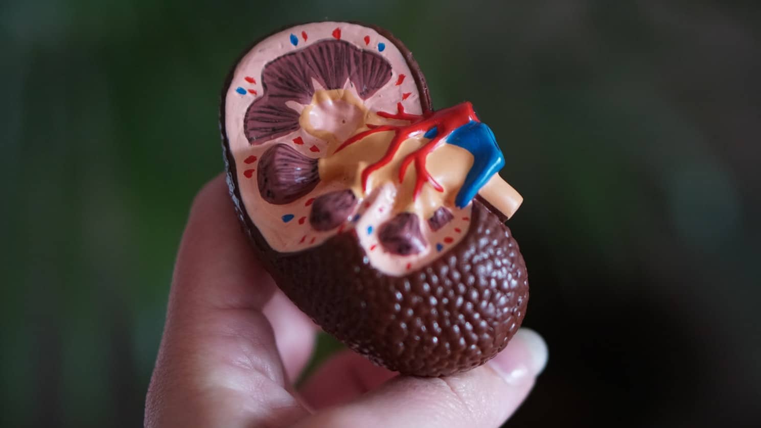 A plastic mold of a human kidney displaying kidney stones