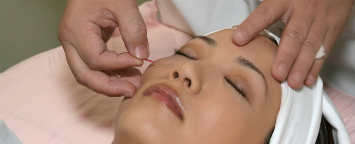 woman receiving acupuncture to help with pms symptoms