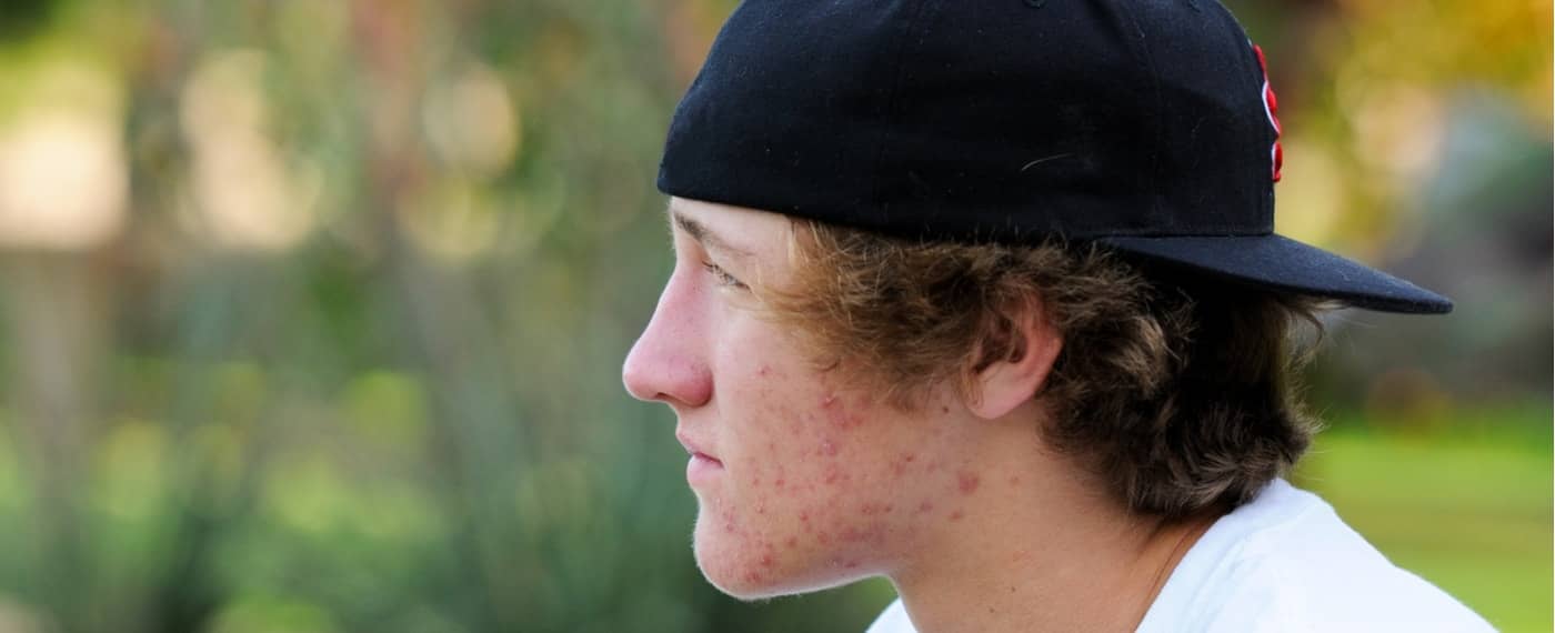 Teenage bot with cystic acne on his face